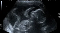 Bebé en el vientre a las 20 semanas, dentro del segundo trimestre, cuando los abortos por desmembramiento se realizan generalmente. Foto: Flickr de Steve (CC BY-NC 2.0)